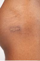 photo texture of scar skin